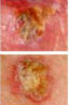 Carcinoma espinocelular