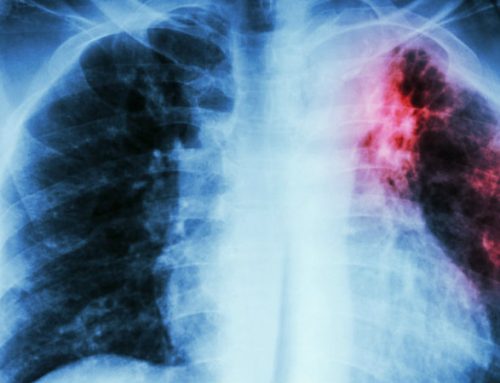 ISPUP lança guia para promover linguagem inclusiva na comunicação sobre tuberculose