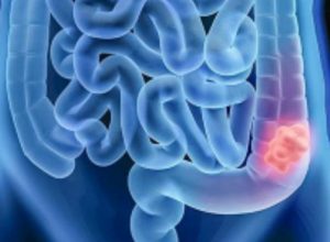 cancro colorretal