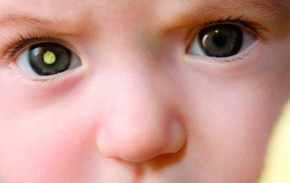 doenças oculares raras