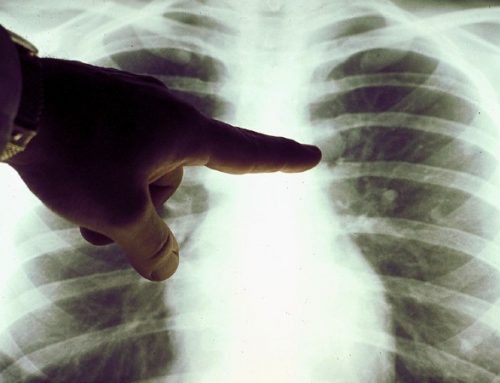 Cancro do pulmão de pequenas células afeta mais os homens
