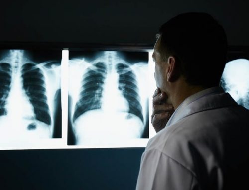 Associações alertam que diagnóstico precoce de cancro do pulmão pode salvar vidas