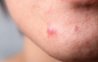 acne fibroblastos