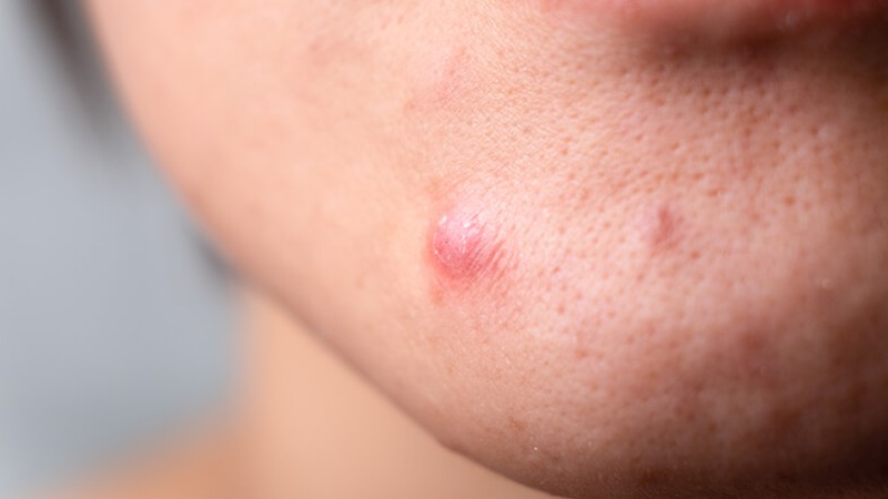 acne fibroblastos