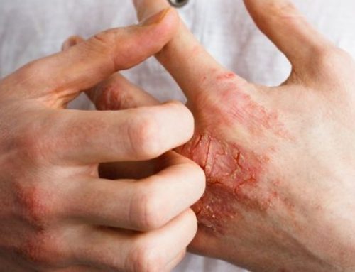 Dermatite atópica. Cuidados diários para controlar os sintomas da doença