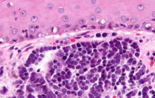 carcinoma de células de merkel