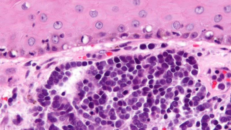 carcinoma de células de merkel