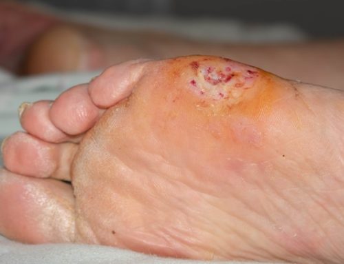 Jornadas sobre a úlcera crónica da perna e pé diabético: “O que há de novo?”