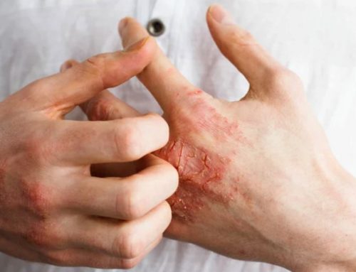  EMA aprova pela primeira vez tralocinumab em adolescentes com dermatite atópica