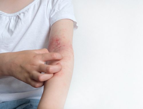  Poluição do ar pode ser causa de eczema
