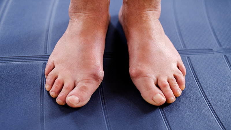 Joanetes: o que é, causas e como tratar