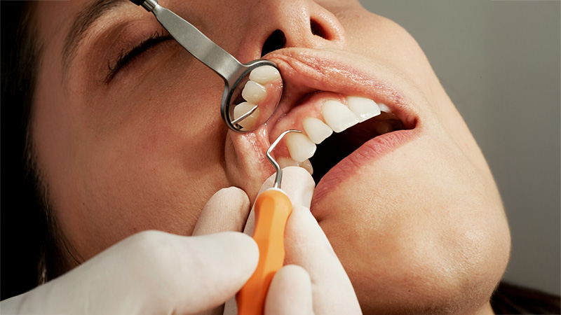 Tudo sobre branqueamento dentário